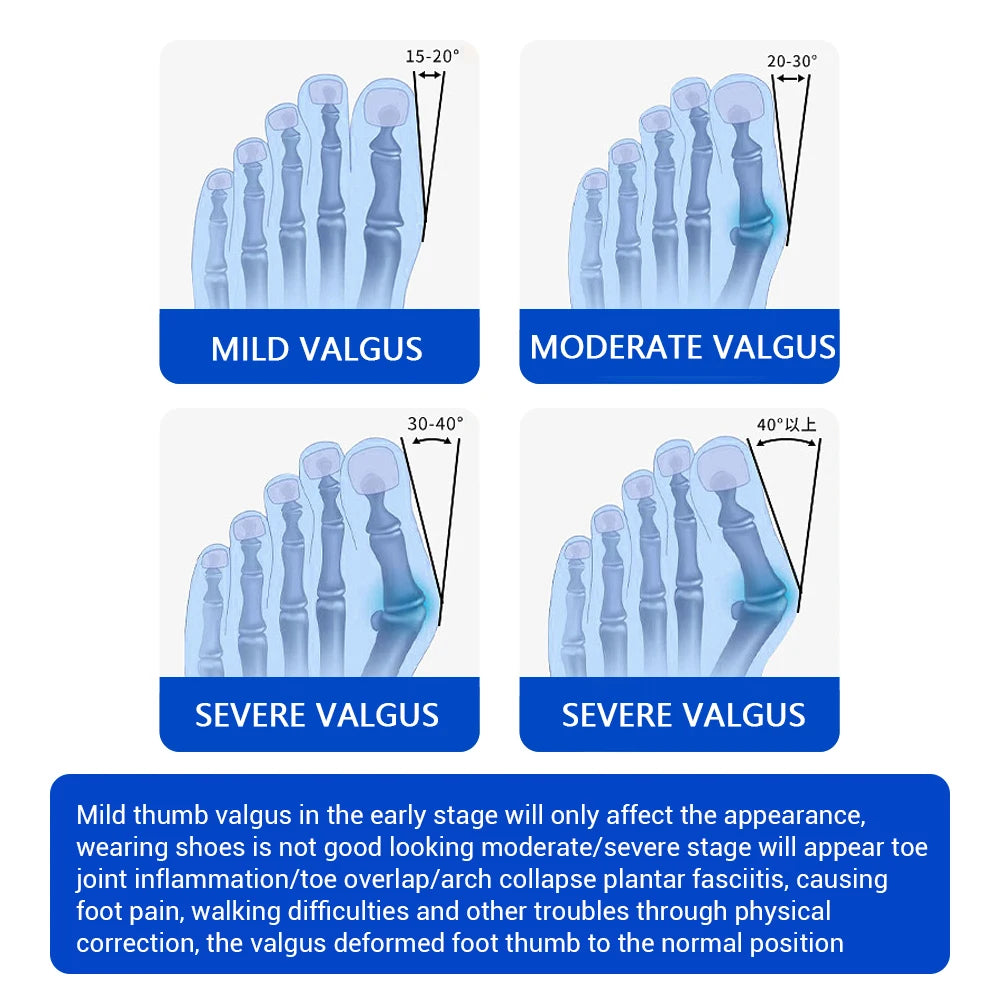 Adjustable Orthopedic Bunion Corrector Device Hallux Valgus Toe Correction Pedicure Foot Care Tool Thumb Big Bone Orthotics